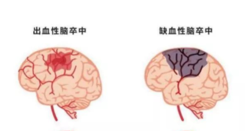 「腦部聽診器」彩色經(jīng)顱多普勒檢測(cè)顱內(nèi)動(dòng)脈